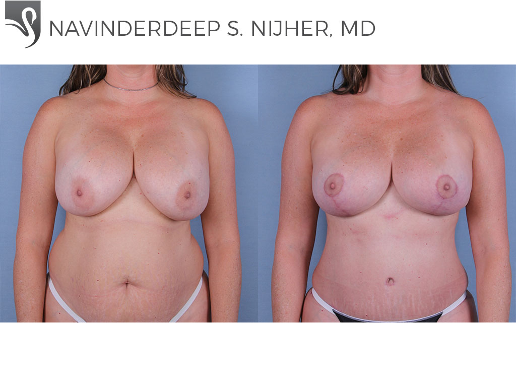 Before and After Image: Breast Lift (Mastopexy) Case #34715 - front
