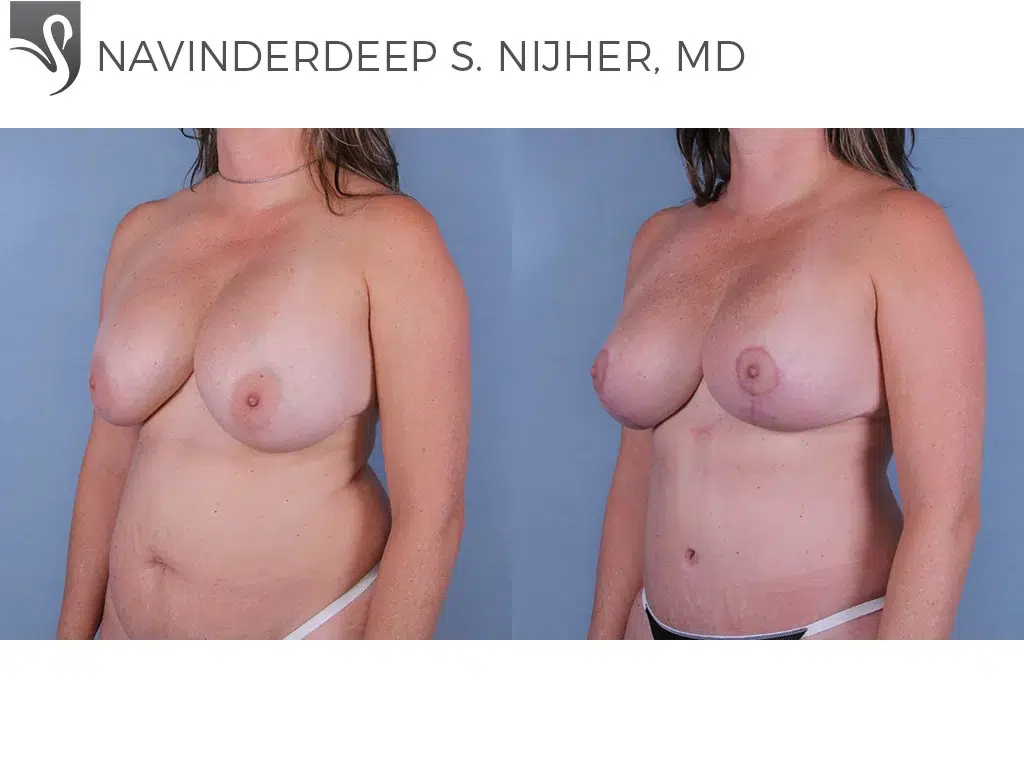 Before and After Image: Breast Lift (Mastopexy) Case #34715 - left-front-oblique