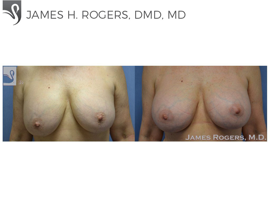 Before and After Image: Breast Revisions Case #35498 - front