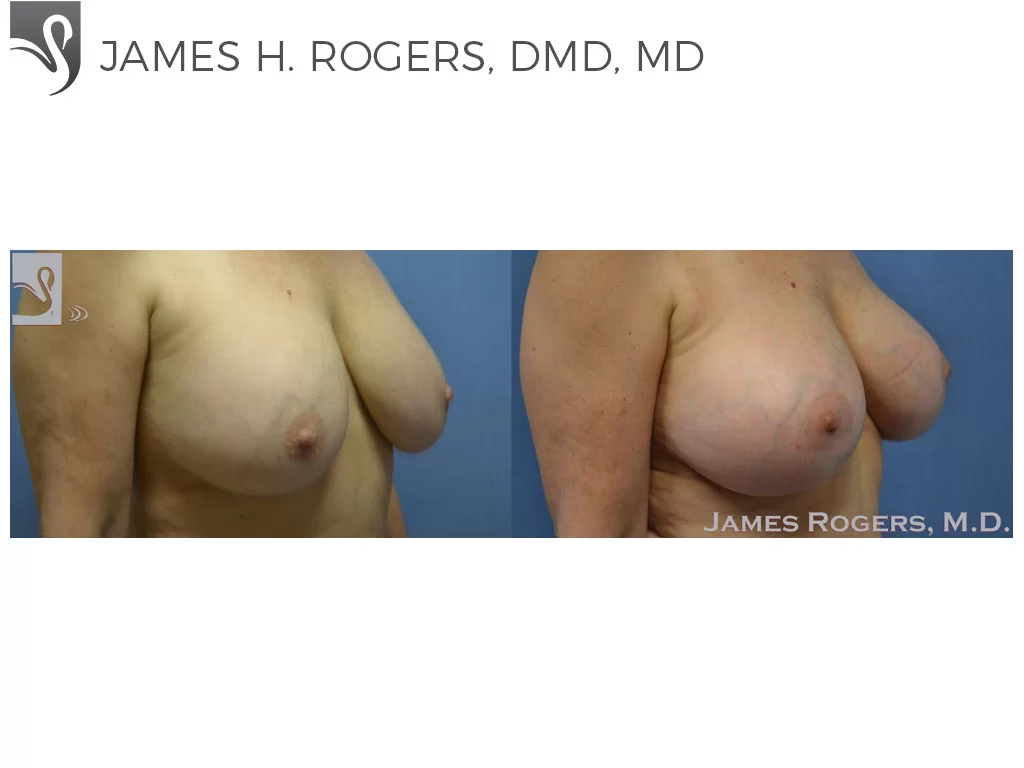 Before and After Image: Breast Revisions Case #35498 - right-front-oblique