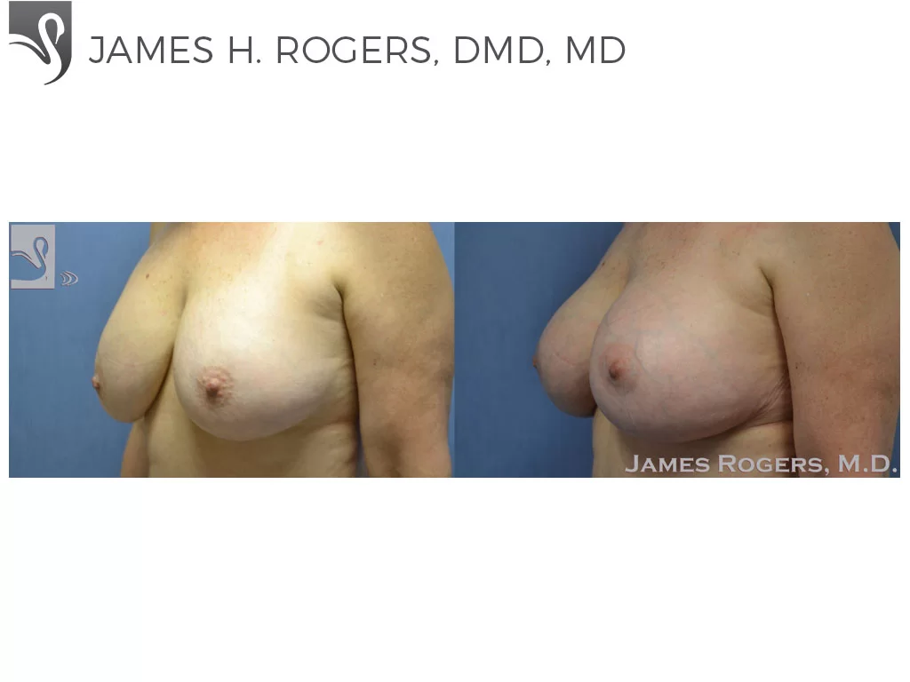Before and After Image: Breast Revisions Case #35498 - left-front-oblique