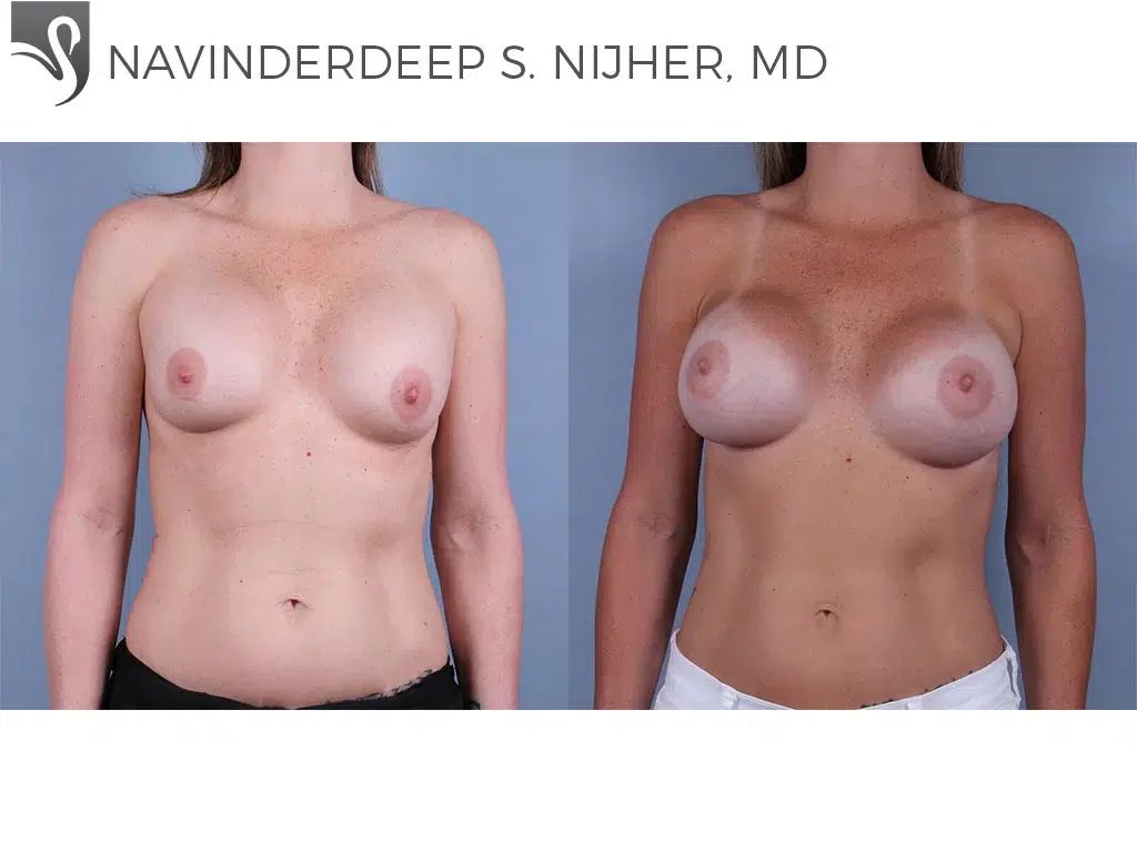 Before and After Image: Breast Revisions Case #35715