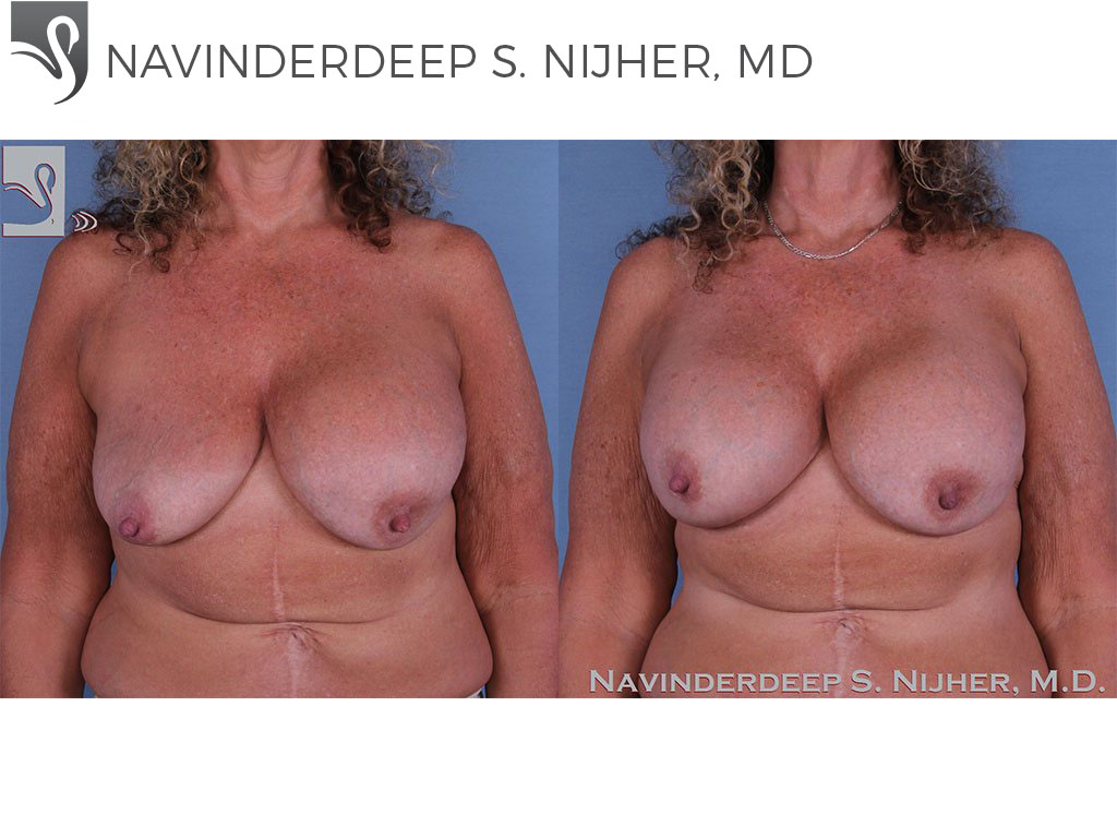 Before and After Image: Breast Revisions Case #35717 - front
