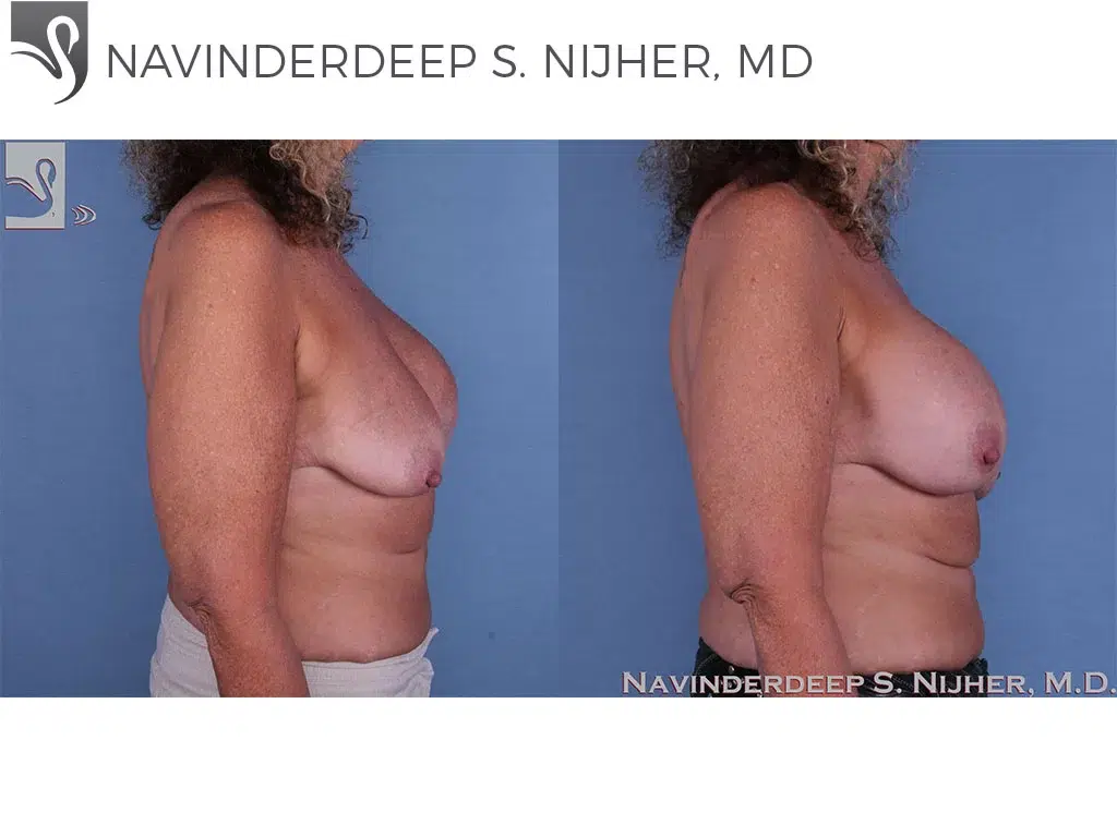 Before and After Image: Breast Revisions Case #35717 - right-side