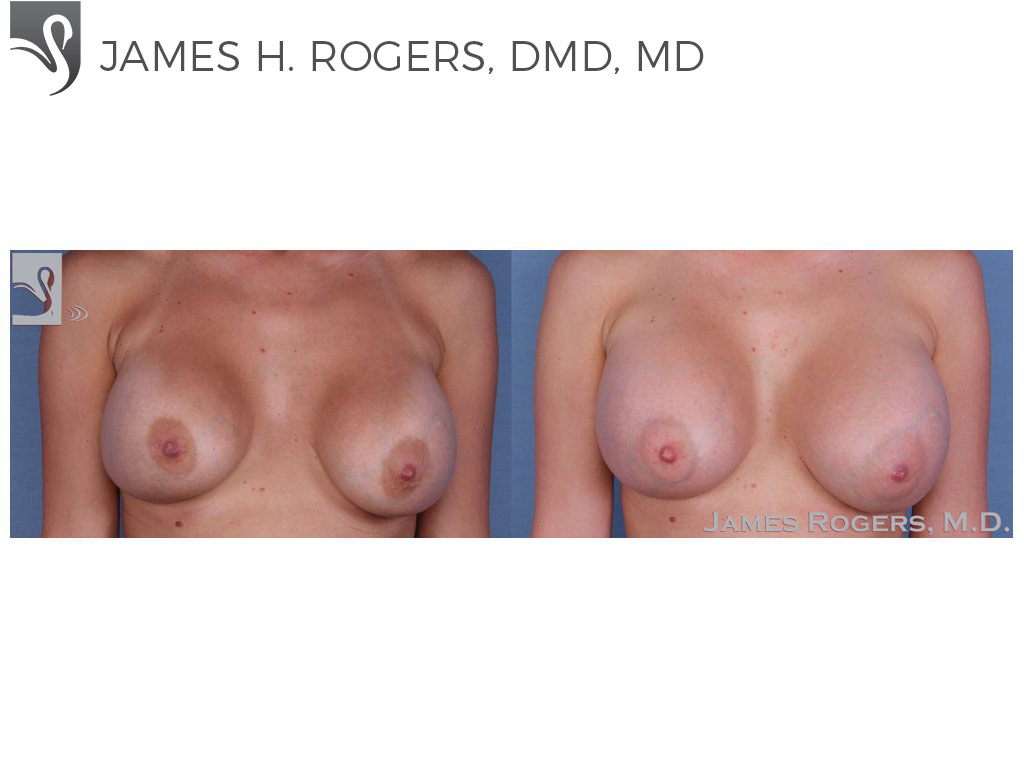 Before and After Image: Breast Revisions Case #36278 - front