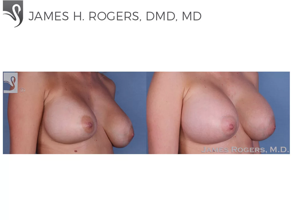 Before and After Image: Breast Revisions Case #36278 - right-front-oblique