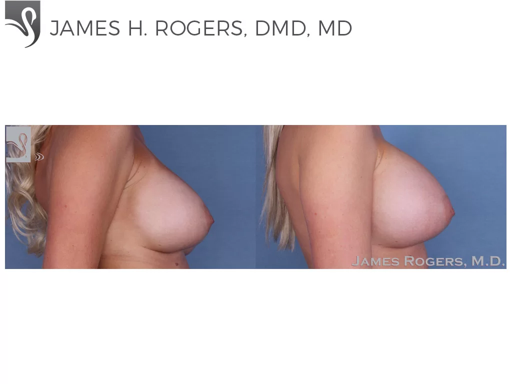 Before and After Image: Breast Revisions Case #36278 - right-side