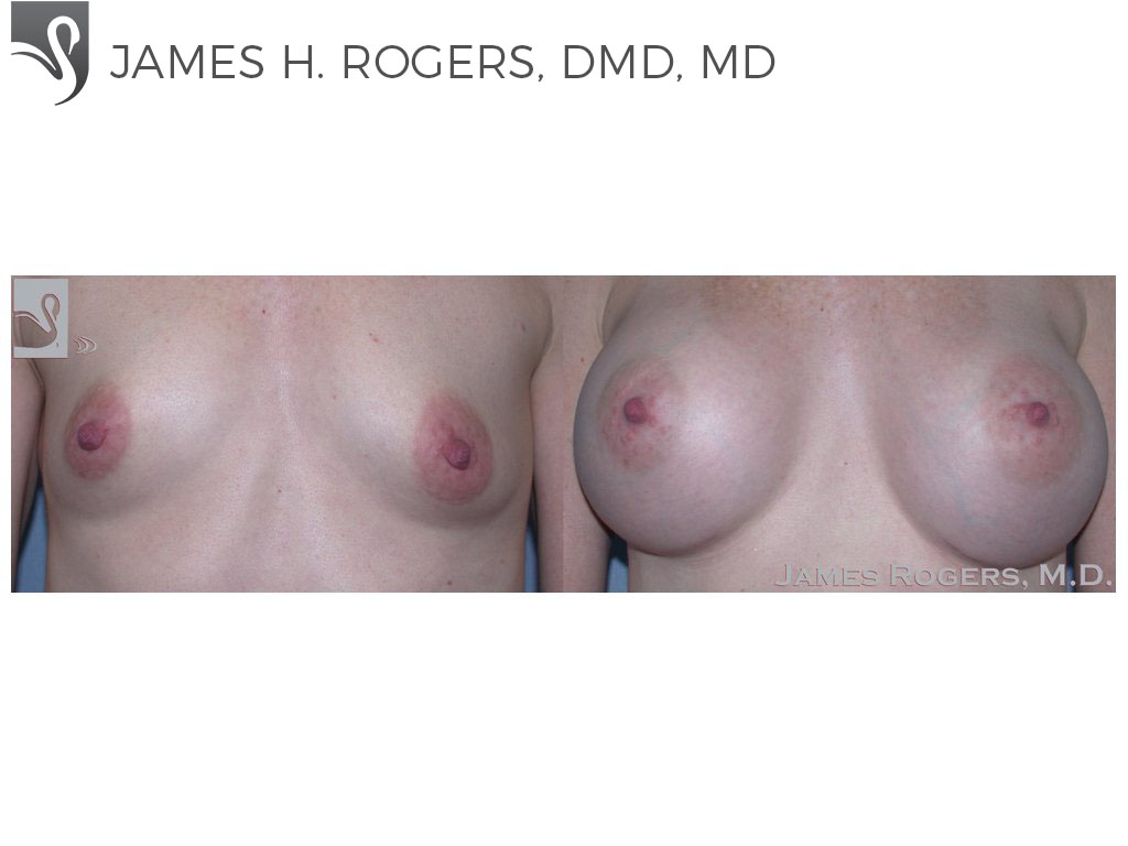 Before and After Image: Breast Augmentation Case #37580 - front