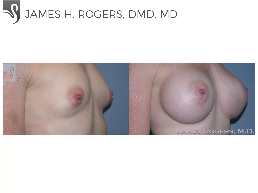 Before and After Image: Breast Augmentation Case #37580 - right-front-oblique