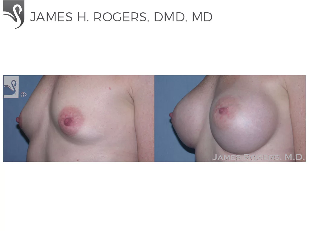 Before and After Image: Breast Augmentation Case #37580 - left-front-oblique