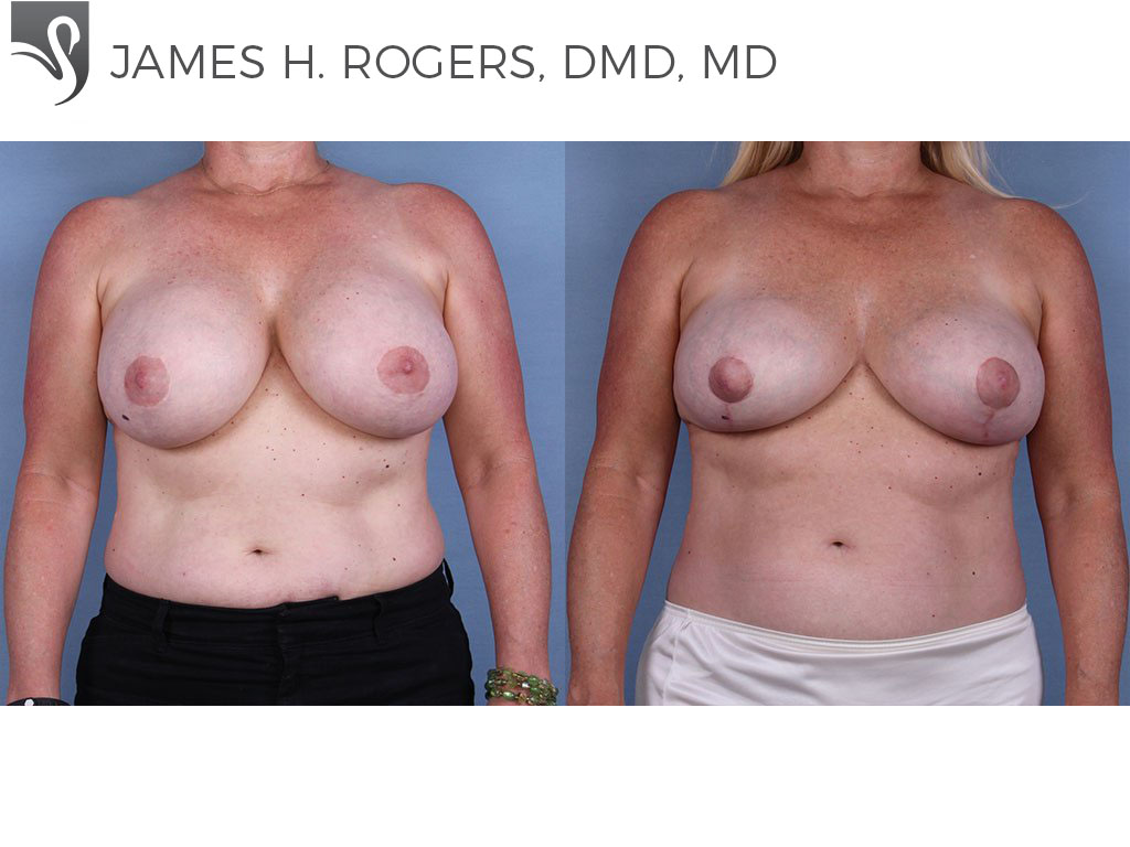 Before and After Image: Breast Revisions Case #37642 - front