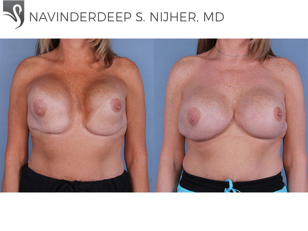 Before and After Image: Breast Reconstruction Case #37901