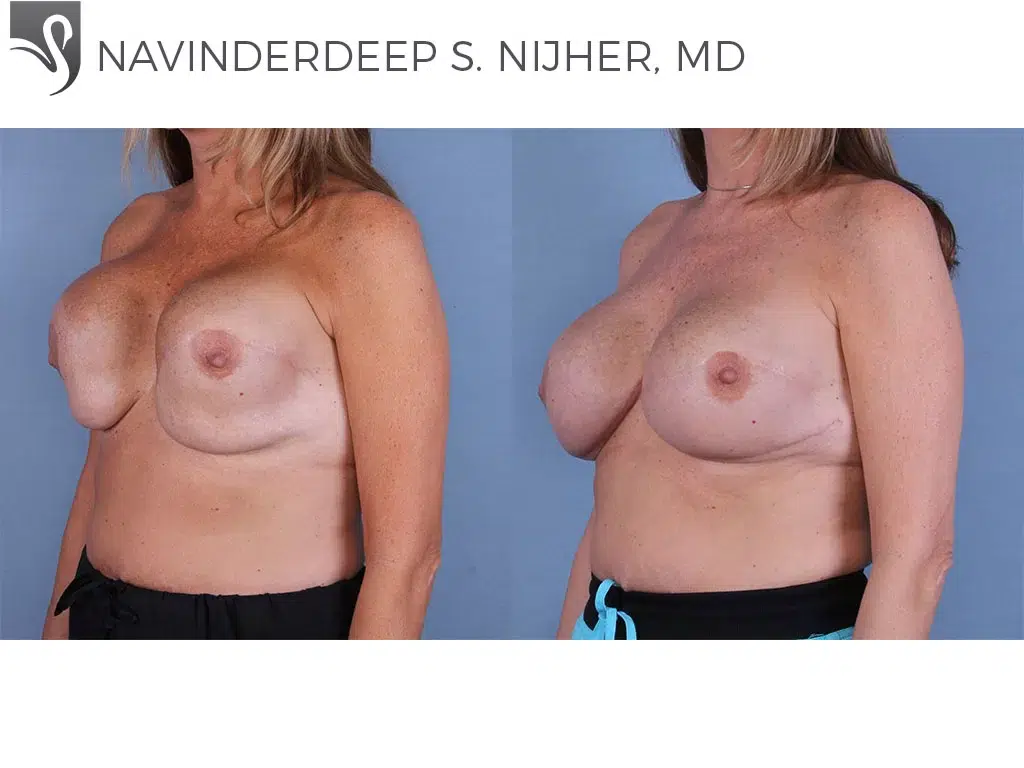 Before and After Image: Breast Reconstruction Case #37901 - left-front-oblique