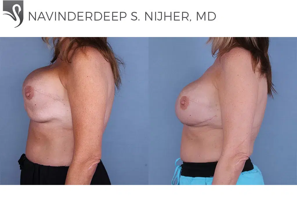 Before and After Image: Breast Reconstruction Case #37901 - left-side
