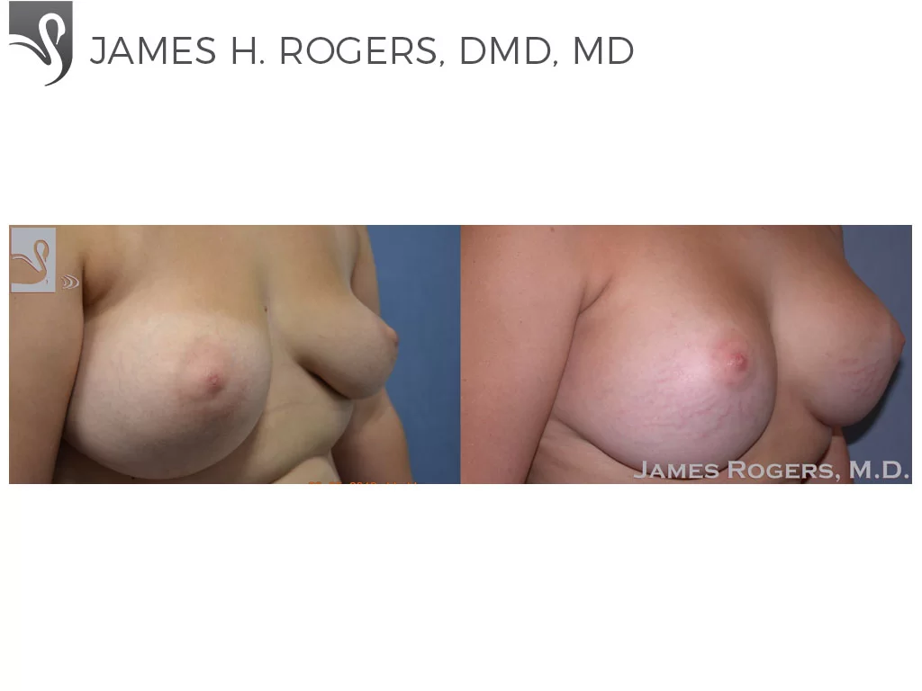 Before and After Image: Breast Revisions Case #38335 - right-front-oblique