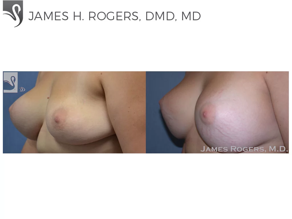 Before and After Image: Breast Revisions Case #38335 - left-front-oblique