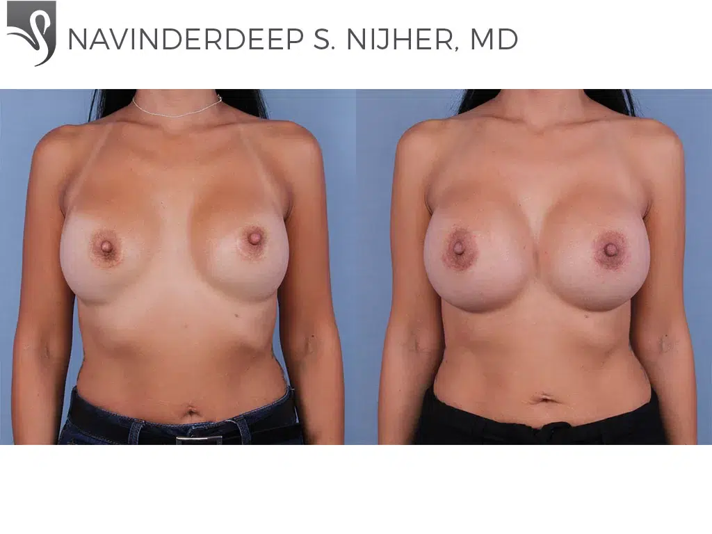 Before and After Image: Breast Augmentation Case #38745 - front