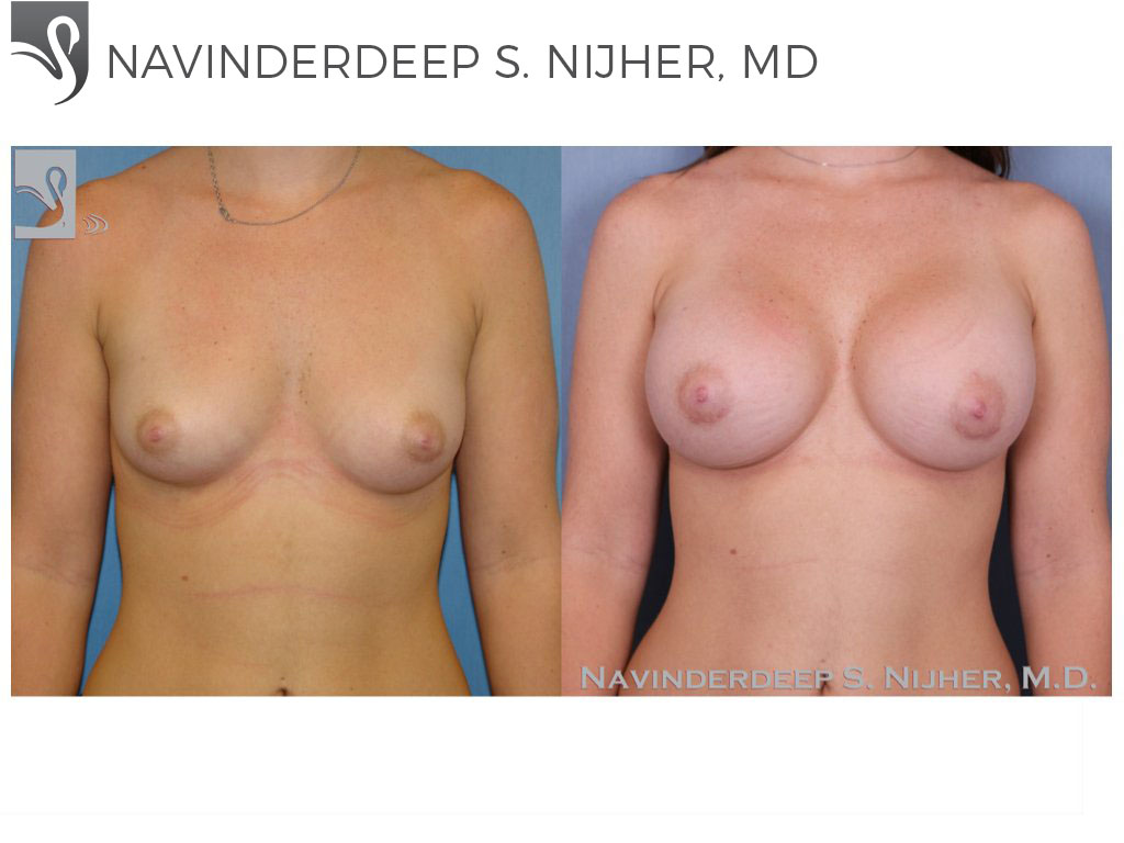 Before and After Image: Breast Augmentation Case #38904 - front