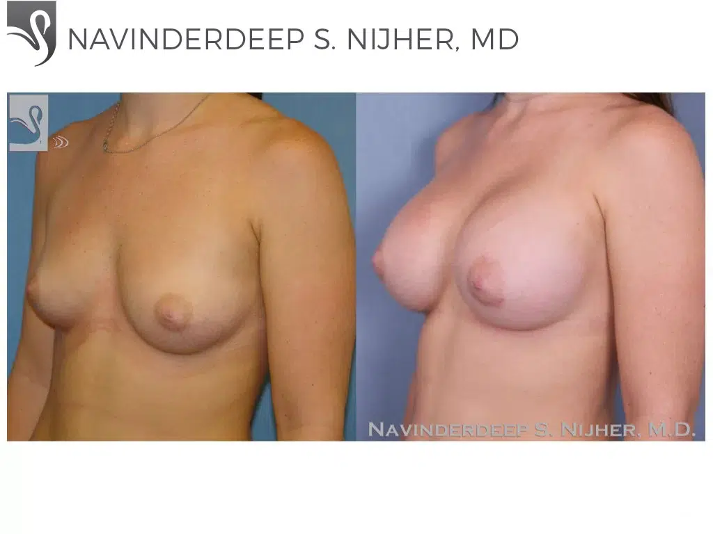 Before and After Image: Breast Augmentation Case #38904 - left-front-oblique