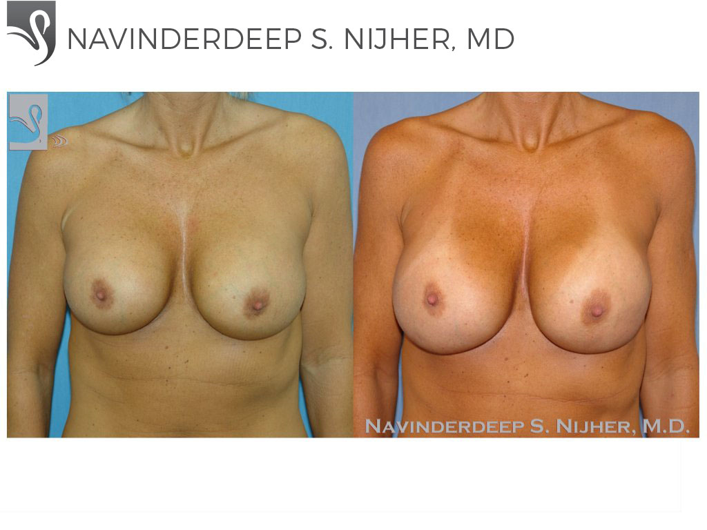 Before and After Image: Breast Revisions Case #38931 - front
