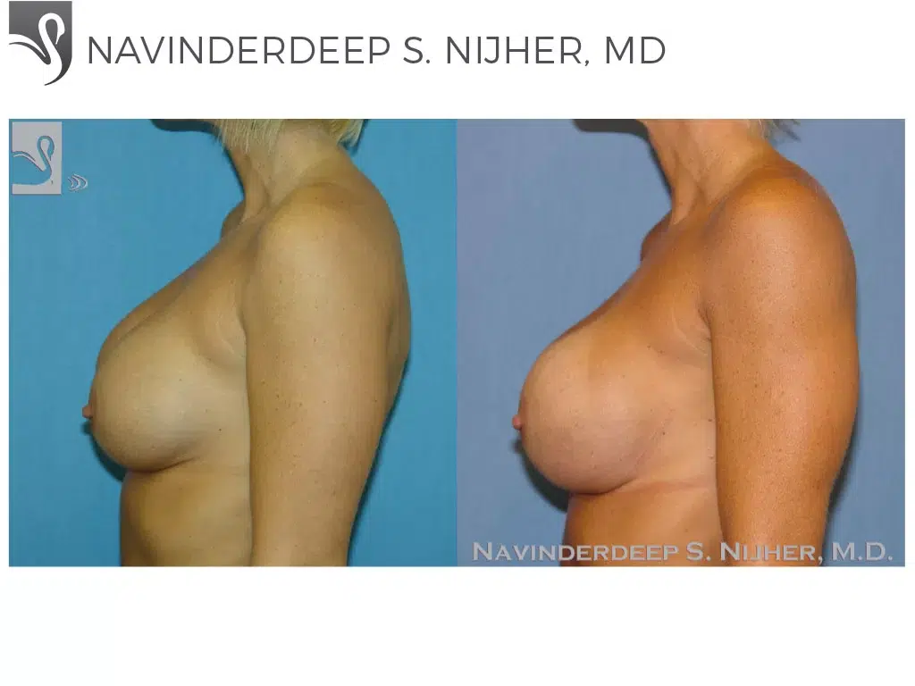 Before and After Image: Breast Revisions Case #38931 - left-side