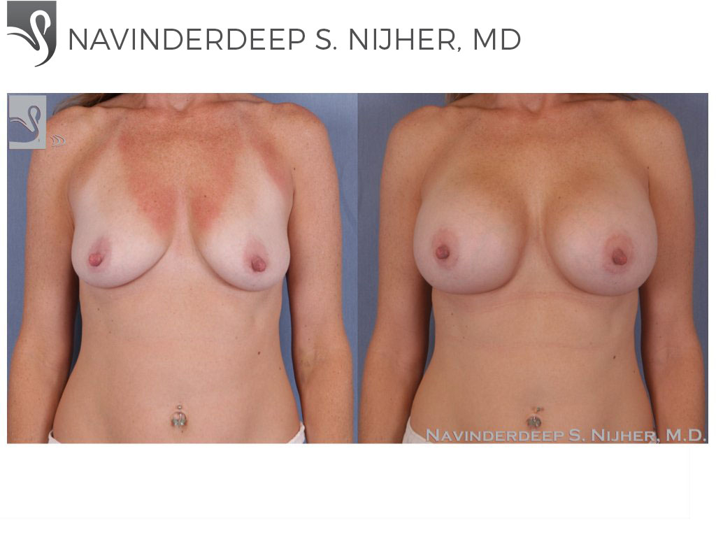Before and After Image: Breast Augmentation Case #39608 - front