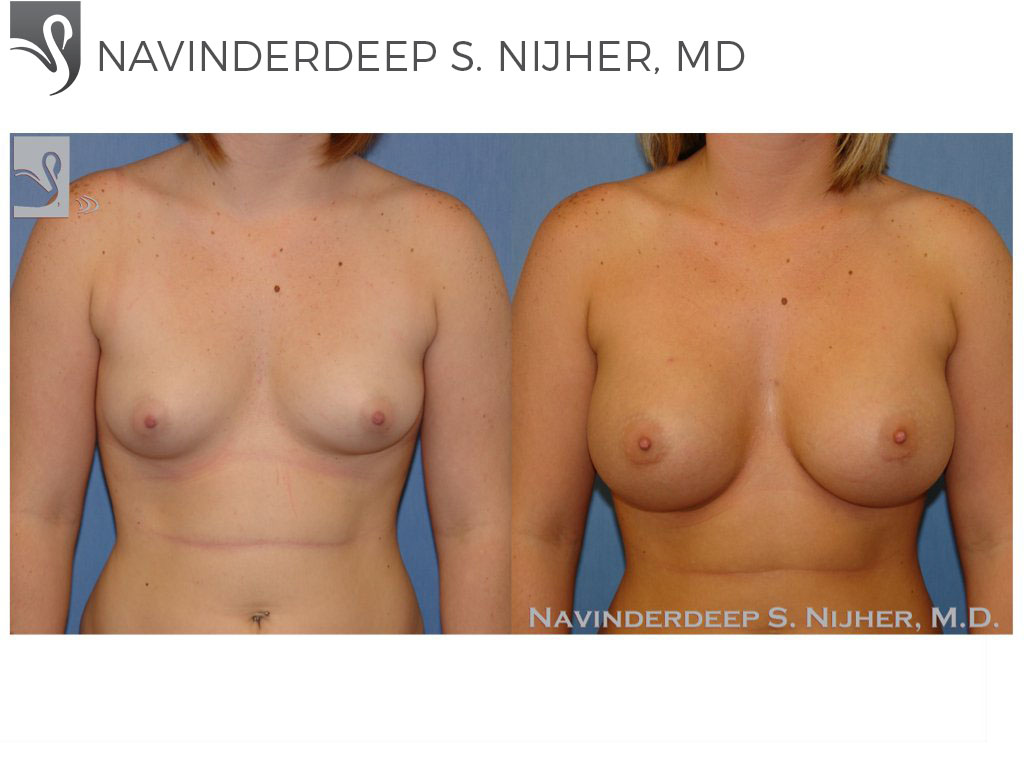 Before and After Image: Breast Augmentation Case #39753 - front