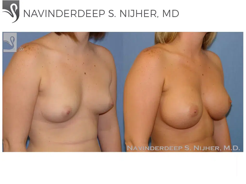 Before and After Image: Breast Augmentation Case #39753 - right-front-oblique