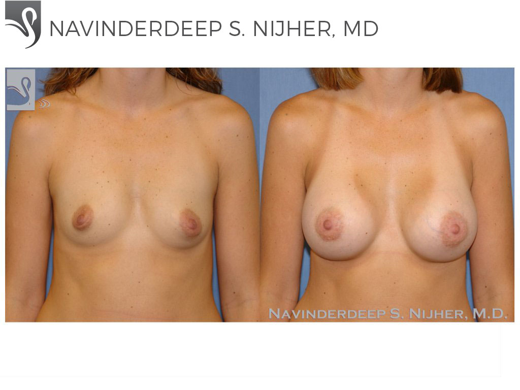 Before and After Image: Breast Augmentation Case #39783 - front