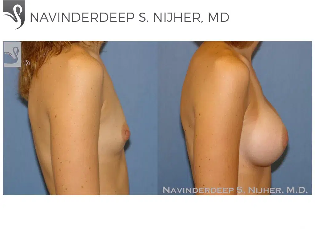 Before and After Image: Breast Augmentation Case #39783 - right-side
