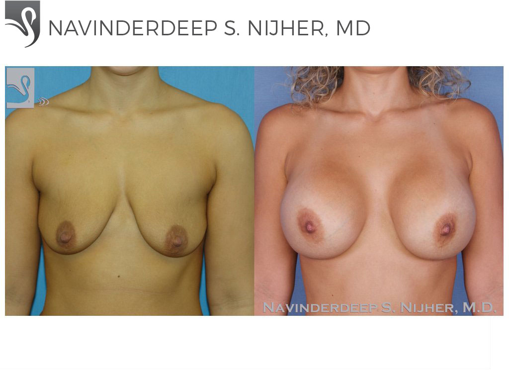 Before and After Image: Breast Augmentation Case #40089 - front