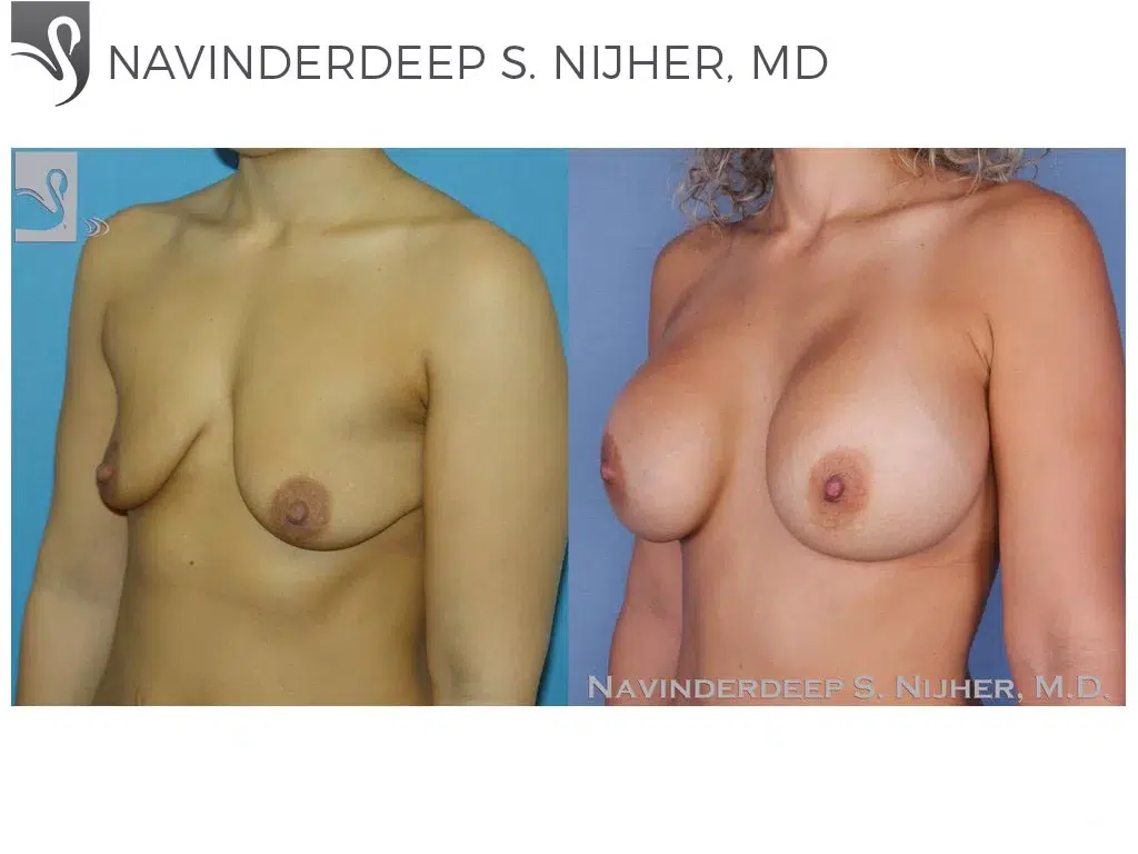 Before and After Image: Breast Augmentation Case #40089 - left-front-oblique