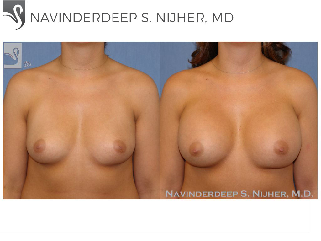 Before and After Image: Breast Augmentation Case #40166 - front