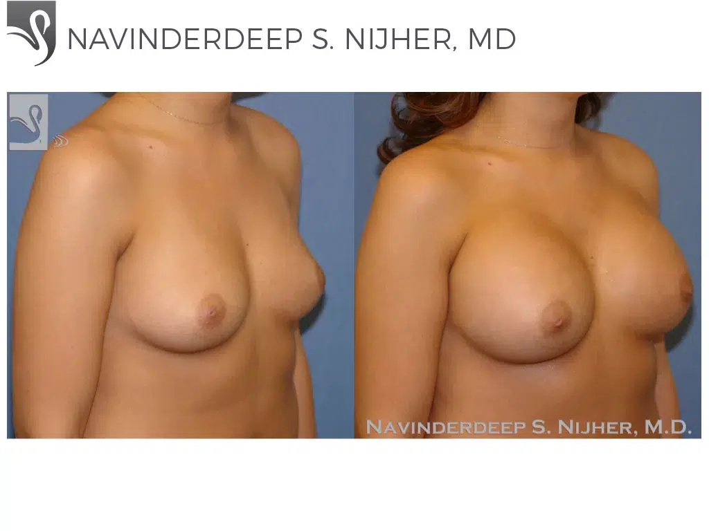 Before and After Image: Breast Augmentation Case #40166 - right-front-oblique