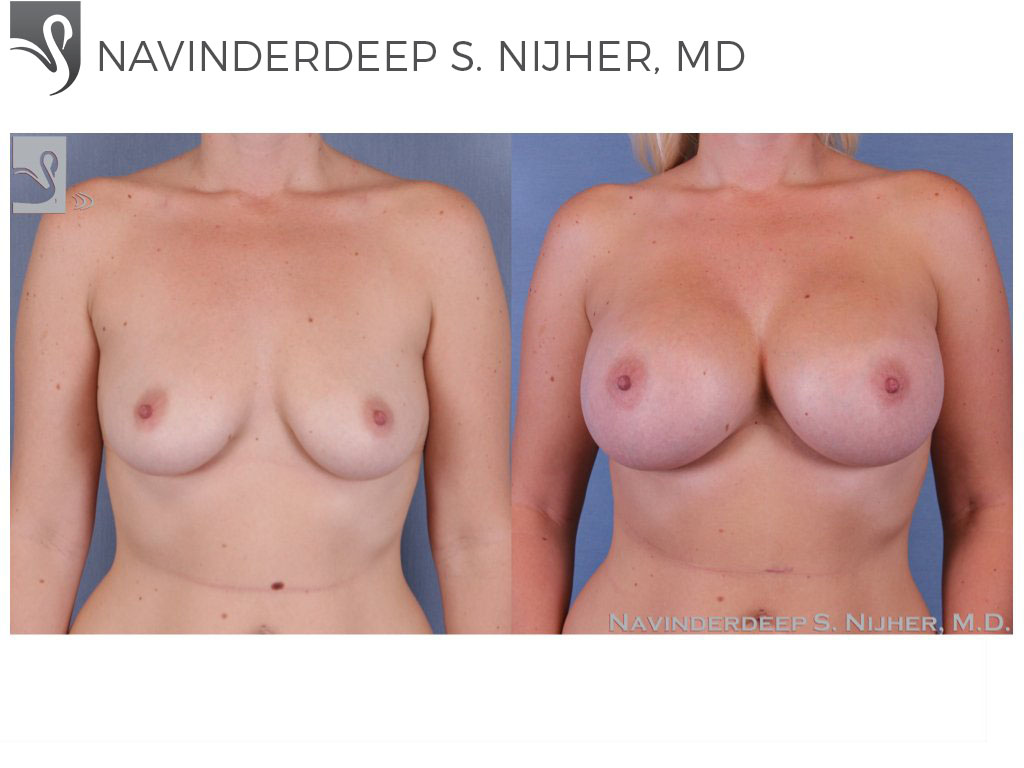 Before and After Image: Breast Augmentation Case #40399 - front
