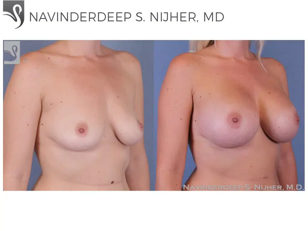 Before and After Image: Breast Augmentation Case #40399 - right-front-oblique