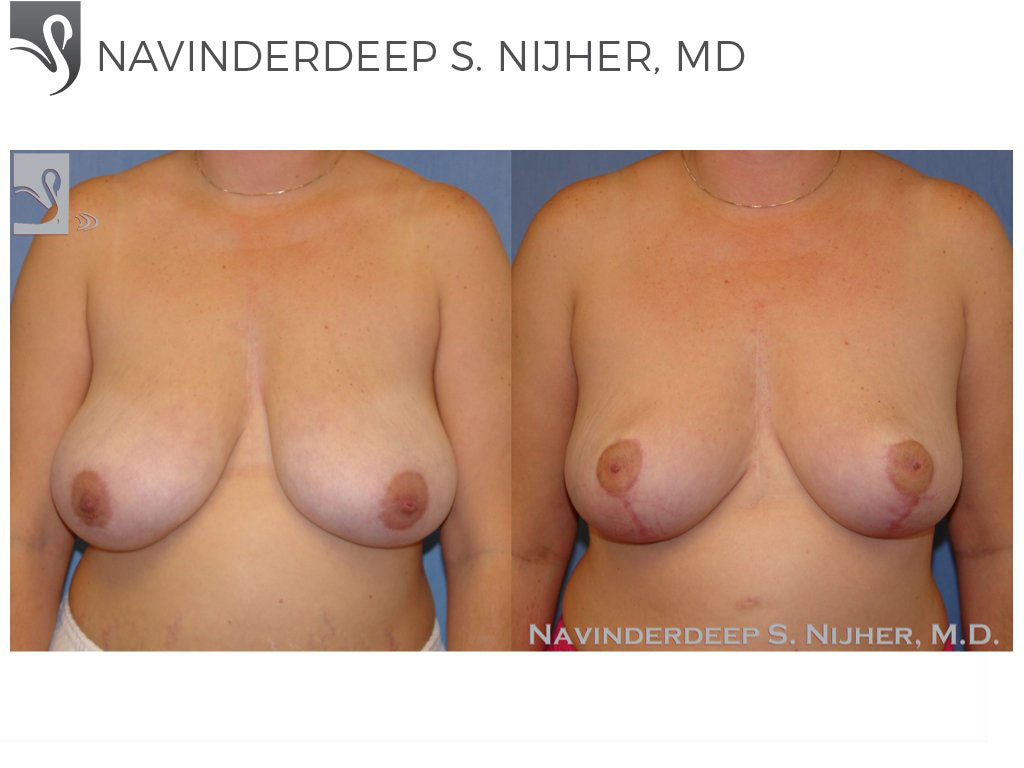 Before and After Image: Female Breast Reduction Case #40479 - front