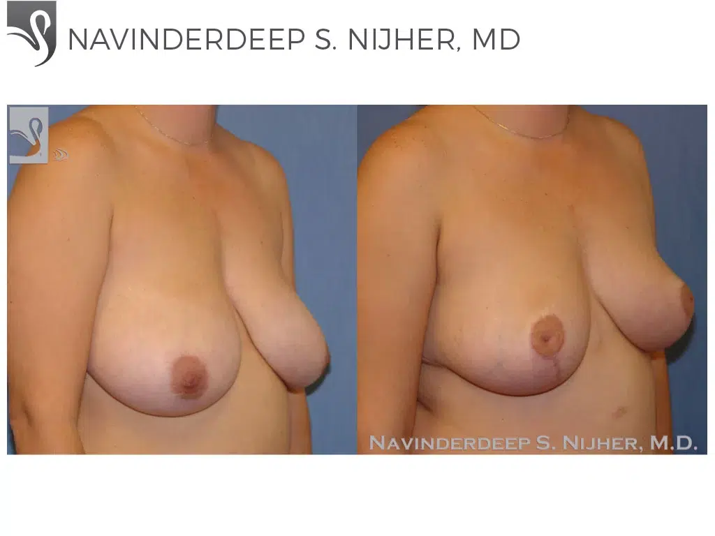 Before and After Image: Female Breast Reduction Case #40479 - right-front-oblique