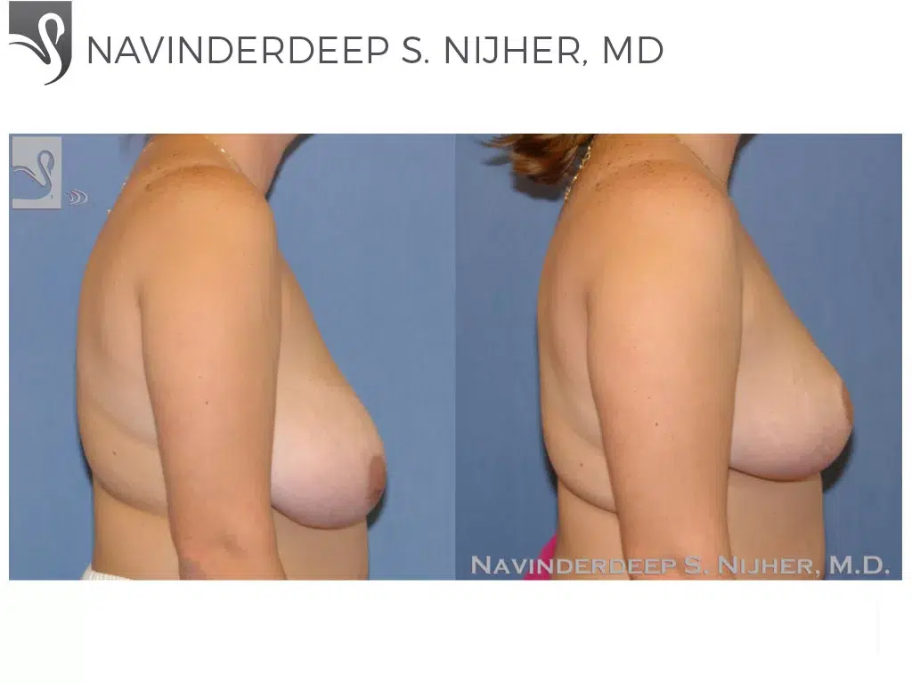 Before and After Image: Female Breast Reduction Case #40479 - right-side