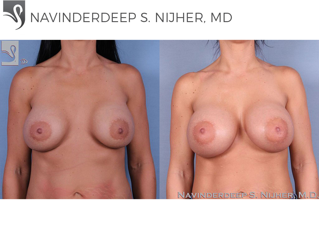 Before and After Image: Breast Revisions Case #40792 - front