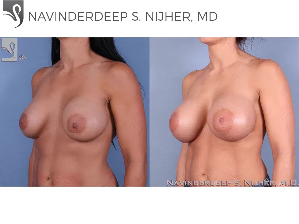 Before and After Image: Breast Revisions Case #40792 - left-front-oblique
