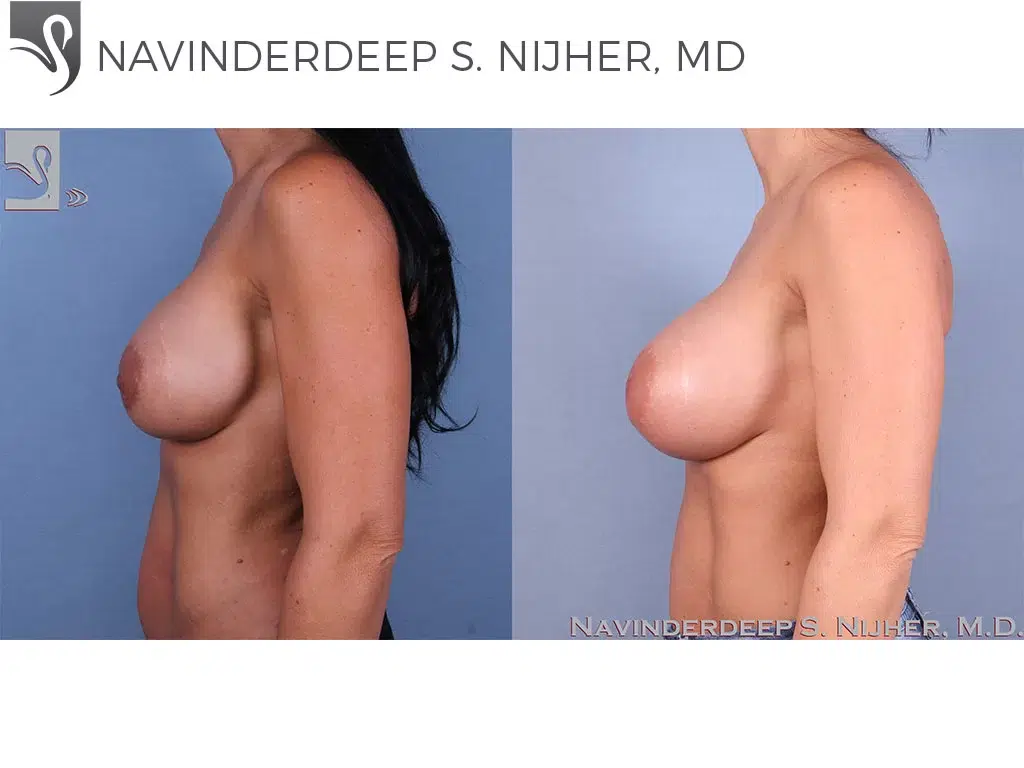 Before and After Image: Breast Revisions Case #40792 - left-side
