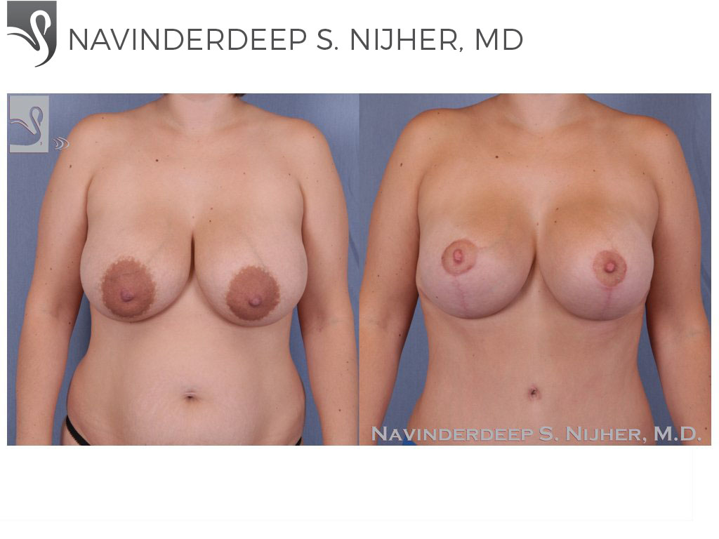 Before and After Image: Breast Revisions Case #60683 - front