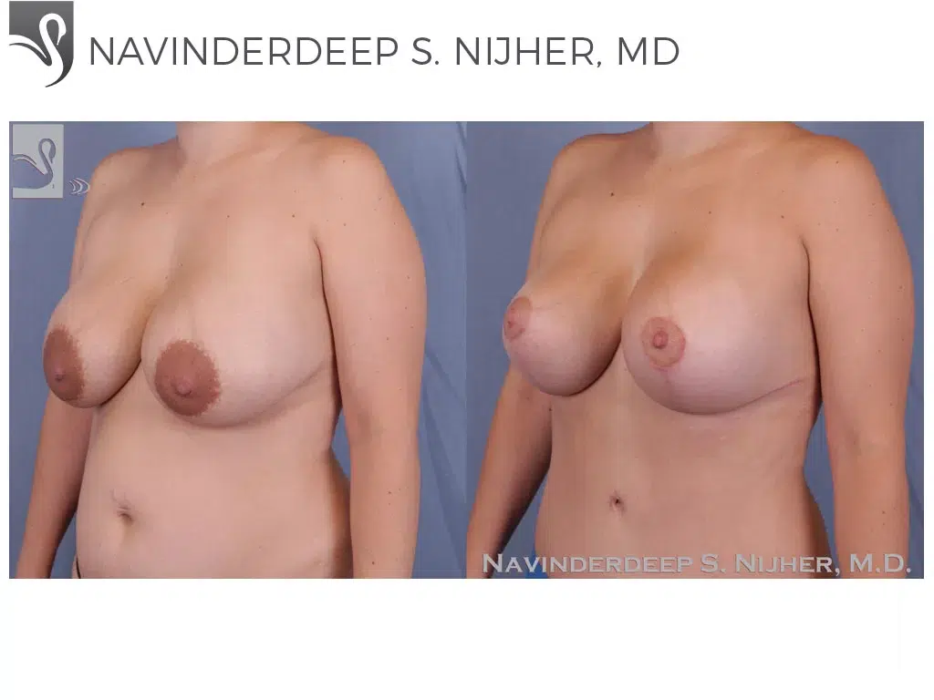 Before and After Image: Breast Revisions Case #60683 - left-front-oblique