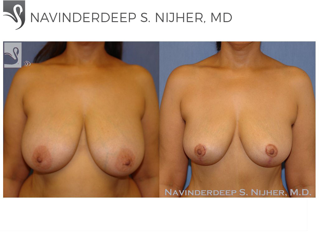 Before and After Image: Breast Lift (Mastopexy) Case #41207 - front