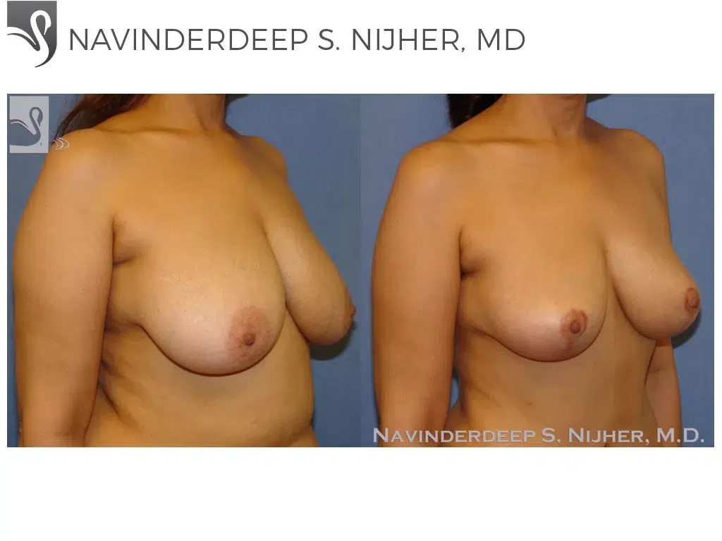 Before and After Image: Breast Lift (Mastopexy) Case #41207 - right-front-oblique