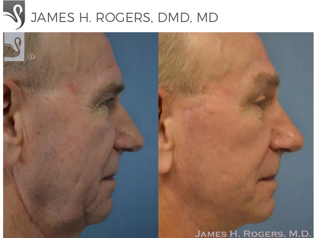 Before and After Image: Brow Lift Case #41275 - right-side