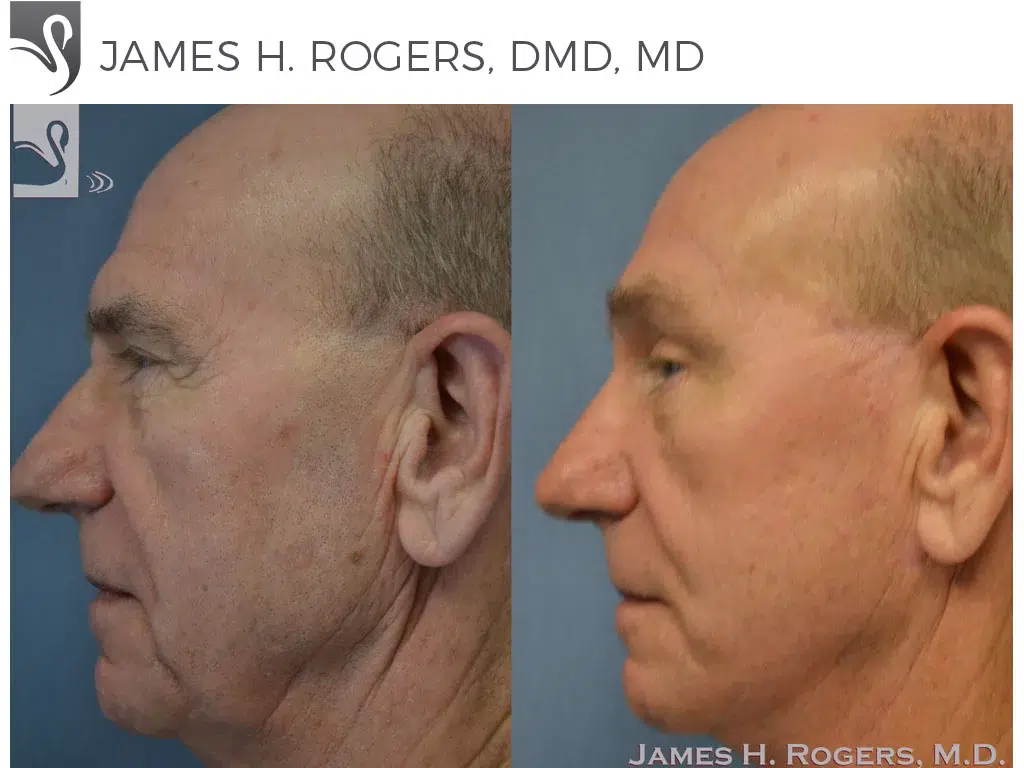 Before and After Image: Brow Lift Case #41275 - left-side