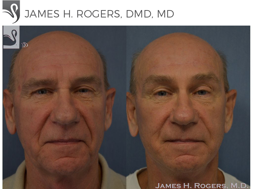 Before and After Image: Face Lift Case #41275 - front