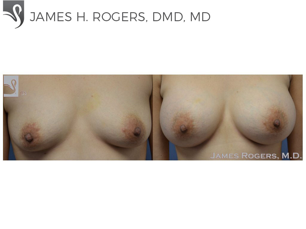 Before and After Image: Breast Augmentation Case #41307 - front